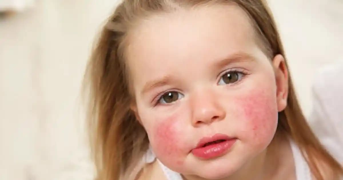 Yüz Yanmasının Nedenleri ve Korunma Yöntemleri Hakkında Detaylı Bilgi