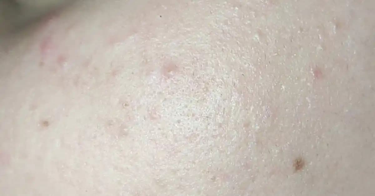 Yüzde Küçük Sivilceler: Nedenleri, Çözüm Yolları ve Bakım İpuçları