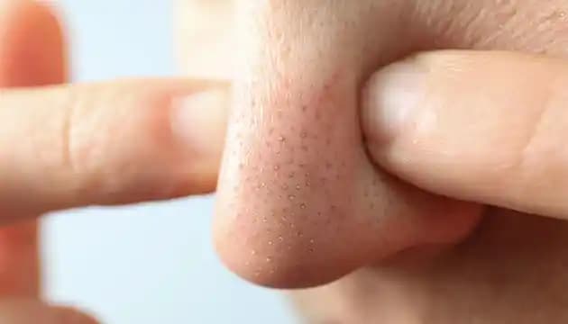 Yüzde Siyah Noktalar Neden Olur ve Etkili Çözüm Yolları Hakkında Detaylı Bilgi