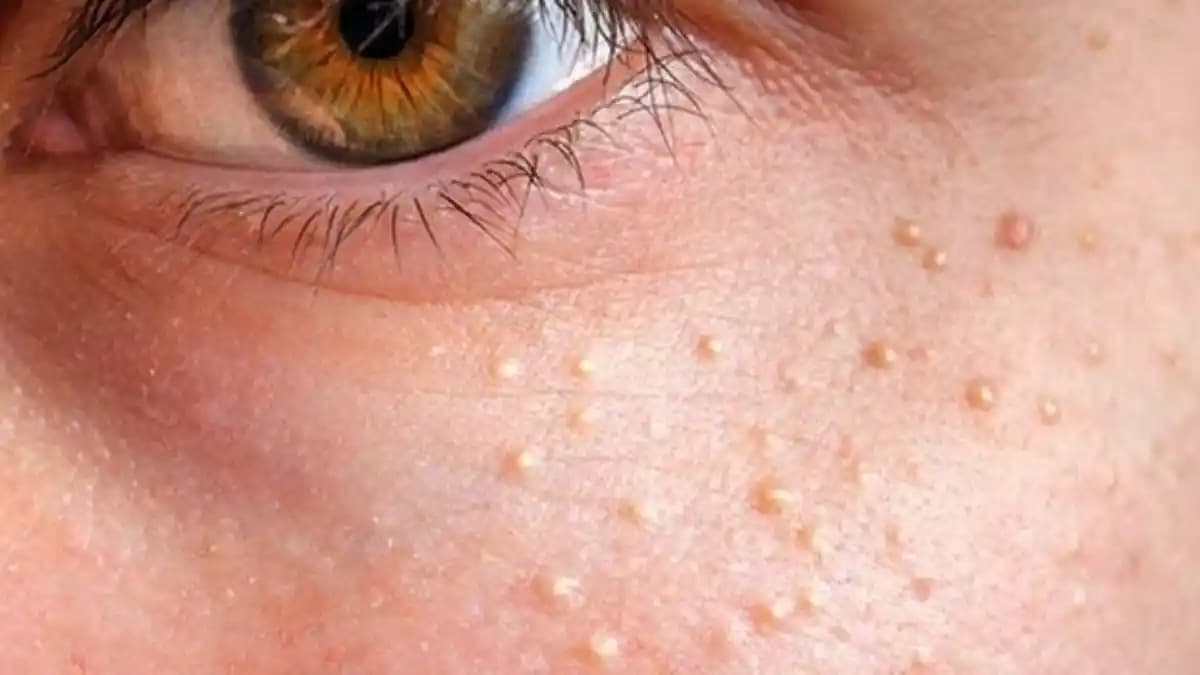 Yüzdeki Komedonlar: Nedenleri, Tedavi Yöntemleri ve Cilt Sağlığı İpuçları