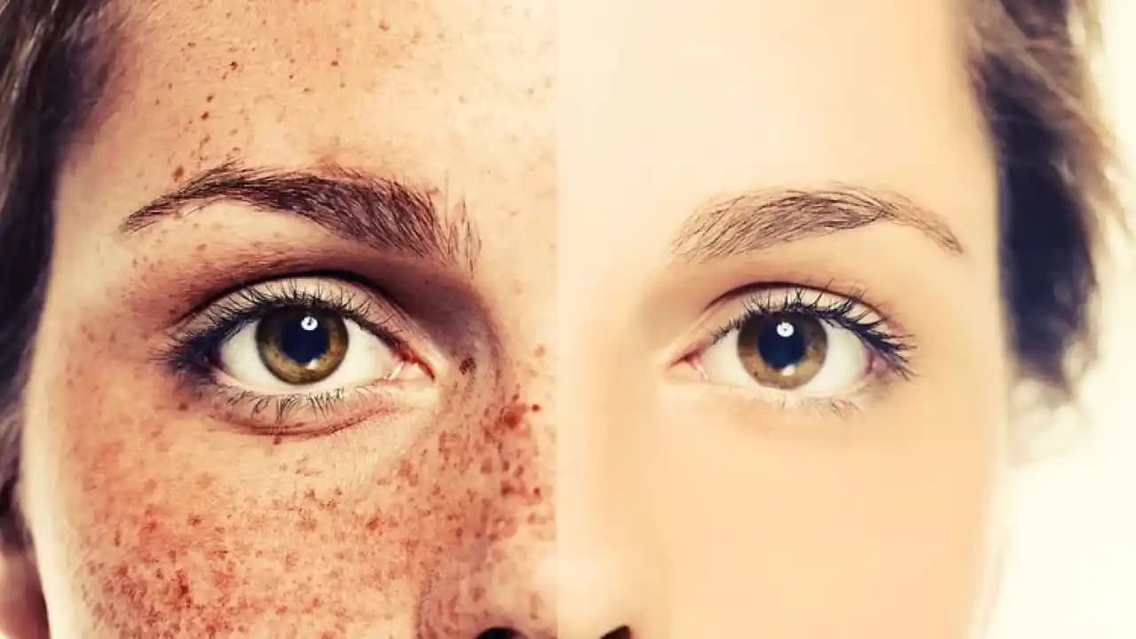 Yüzdeki Lekeler İçin Kalıcı Çözüm Rehberi: Güzellik ve Kendine Güven Artırıcı Yöntemler