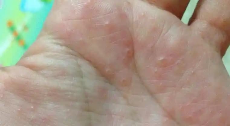 Avuç İçinde Egzama Nedenleri ve Belirtileri Hakkında Detaylı Bilgi