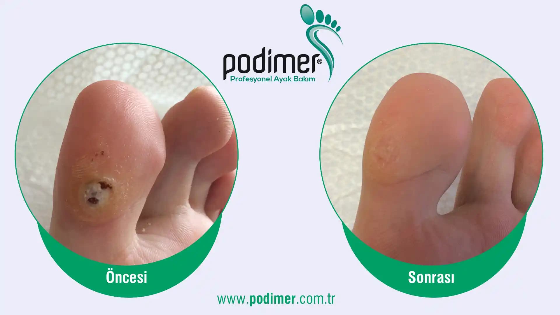 Ayak Siğili ve Kozmetik Boyutu: Sağlıklı ve Estetik Ayaklar İçin Rehber