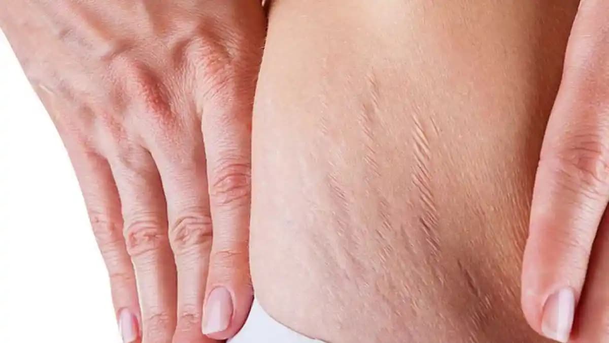 Bacakta Çatlaklar: Nedenleri, Çözüm Yolları ve Etkili Bakım Tavsiyeleri