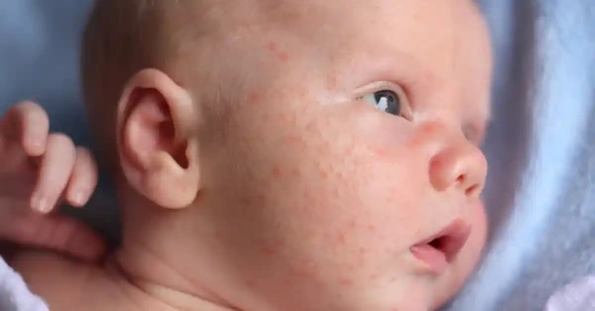 Bebek Yüzünde Sivilce Nedenleri ve Güvenli Bakım Yöntemleri