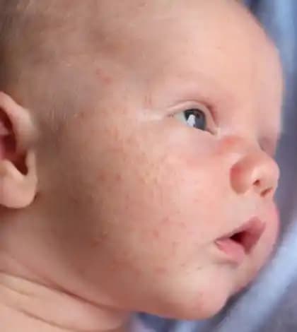 Bebeklerde Akne: Nedenleri, Bakım Yöntemleri ve Doğal Çözümler Hakkında Bilgiler