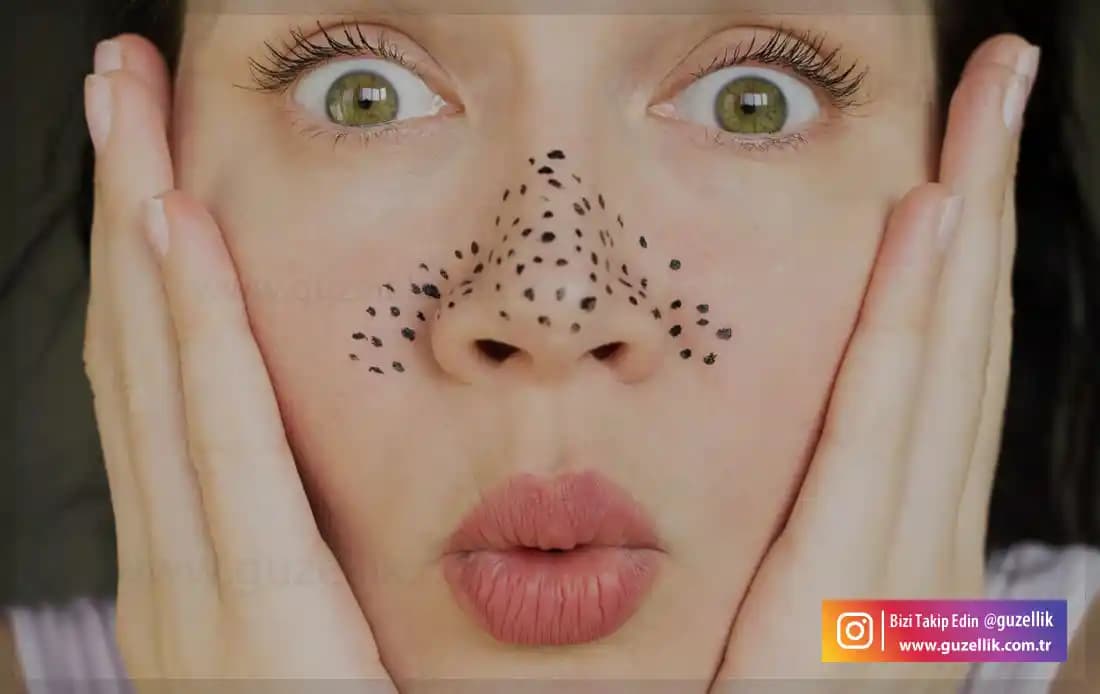 Burun Üzerindeki Siyah Noktalar: Nedenleri, Çözüm Yolları ve Bakım İpuçları
