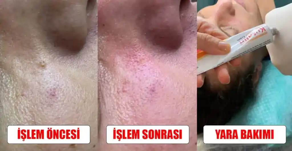 Cilt Bakımı Sonrası Yaraların Hızlı ve Sağlıklı İyileşmesi İçin Etkili Yöntemler
