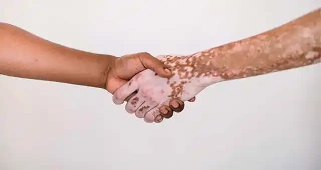 Ciltte Beyaz Lekelerin Nedenleri ve Etkili Tedavi Yöntemleri Hakkında Kapsamlı Rehber