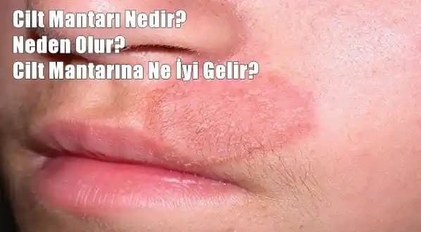 Ciltte Mantar Nedenleri, Belirtileri ve Etkili Tedavi Yöntemleri Hakkında Bilgiler