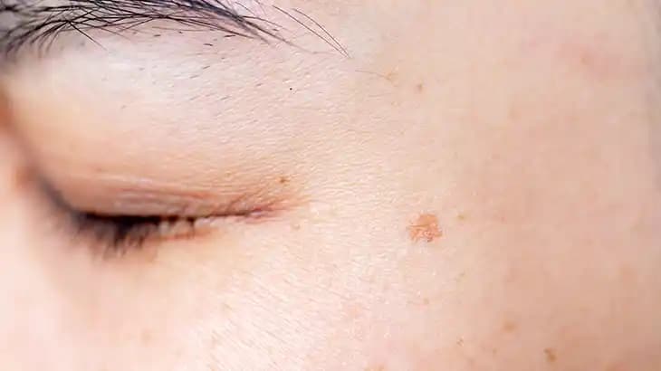 Ciltte Siyah Lekeler: Nedenleri, Tedavi Yöntemleri ve Güncel Bakım Trendleri