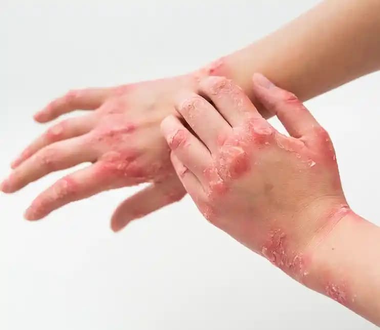 Deride Kabarcıkların Nedenleri ve Kozmetik Çözüm Yöntemleri Hakkında Kapsamlı Rehber