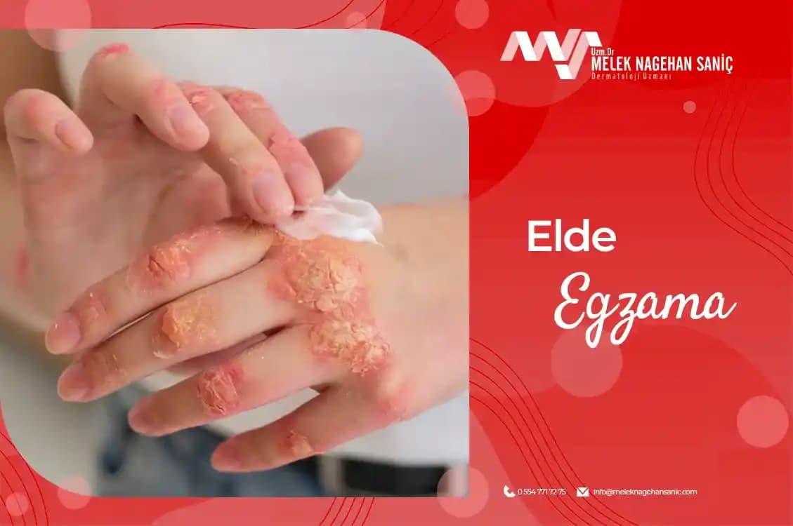 El Sulu Egzama: Belirtileri, Nedenleri ve Kozmetik Bakım İpuçlarıyla Etkili Çözüm Yolları