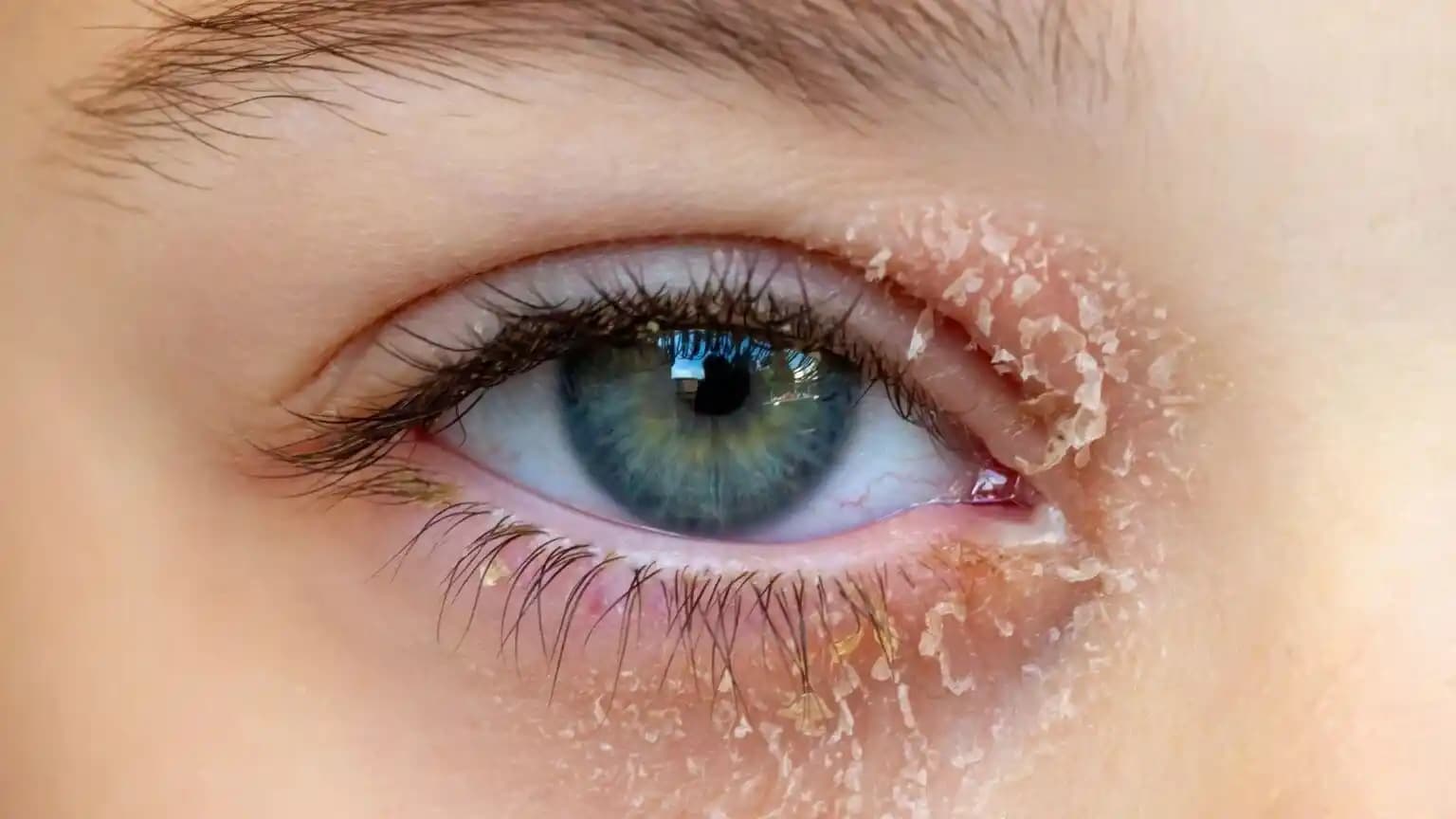 Gözde Egzama Belirtileri, Kozmetik Etkileri ve Etkili Bakım Yöntemleri