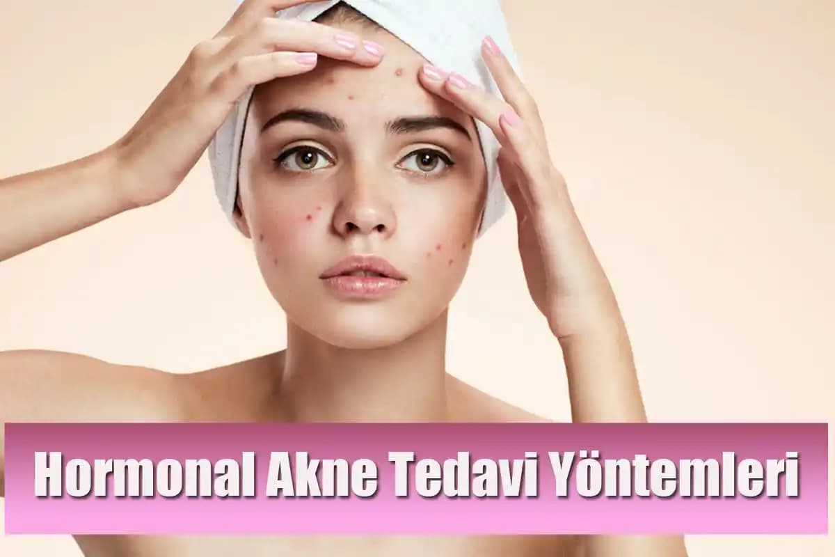Hormonal Sivilceler: Belirtileri, Nedenleri ve Etkili Çözüm Yolları