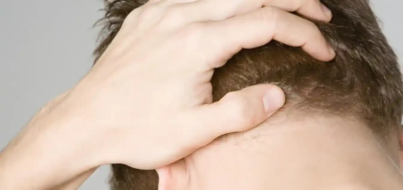 Kafa Derisi Kaşıntısı ve Bakım Yöntemleri: Sağlıklı Saçlar İçin İpuçları