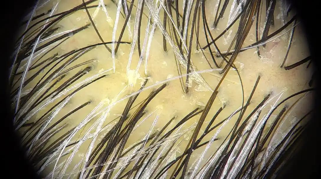 Kafa Derisinde Egzama Nedenleri Belirtileri ve Etkili Çözüm Yolları