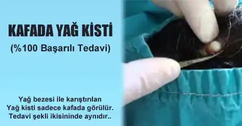 Kafa Derisinde Yağ Bezi (Lipom) Nedir ve En Etkili Tedavi Yöntemleri Nelerdir