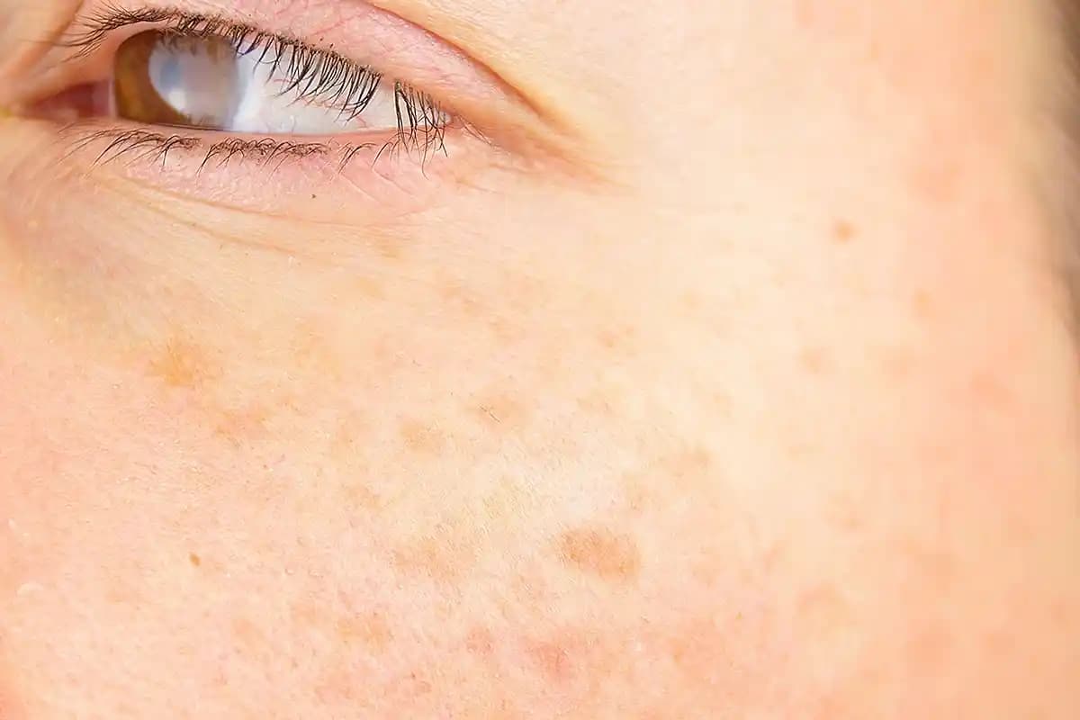 Koldaki Güneş Lekeleri Nasıl Geçer: Nedenleri ve Etkili Tedavi Yöntemleri