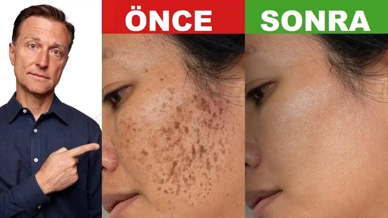 Koyu Lekelerle Mücadelede Güncel ve Etkili Yöntemler ve Koruyucu İpuçları