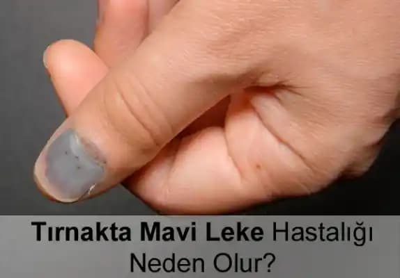 Mavi Leke Nedir, Nedenleri ve Çözüm Yolları Hakkında Kapsamlı Bilgi