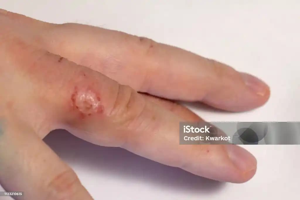 Parmak Egzaması Nedir, Belirtileri ve Kozmetik Ürünlerle Başa Çıkma Yöntemleri