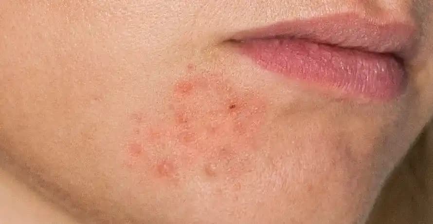 Perioral Dermatitin Belirtileri, Nedenleri ve Etkili Tedavi Yöntemleri Hakkında Detaylı Bilgi