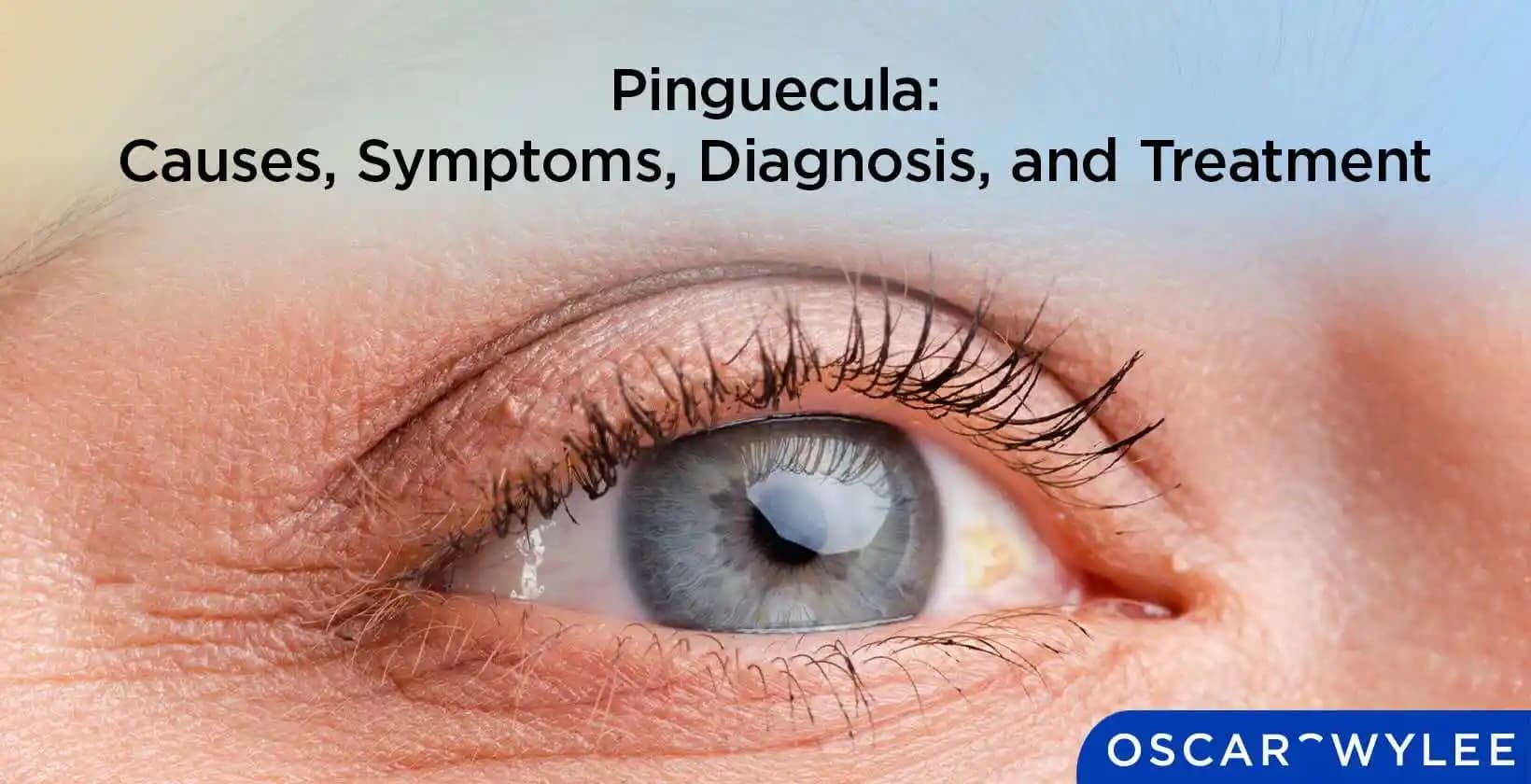 Pinguekula Nedir Göz Sağlığı ve Estetiği Üzerindeki Etkileri Nelerdir