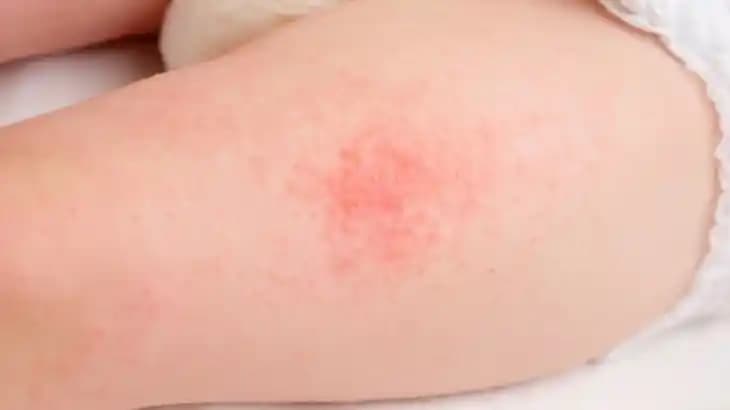 Pişik Nedenleri, Belirtileri ve Korunma Yöntemleri Hakkında Detaylı Bilgi