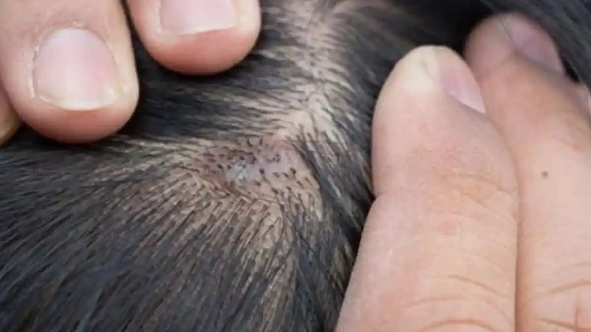 Saç Derisi Yarası Nedenleri, Belirtileri ve Etkili Tedavi Yöntemleri