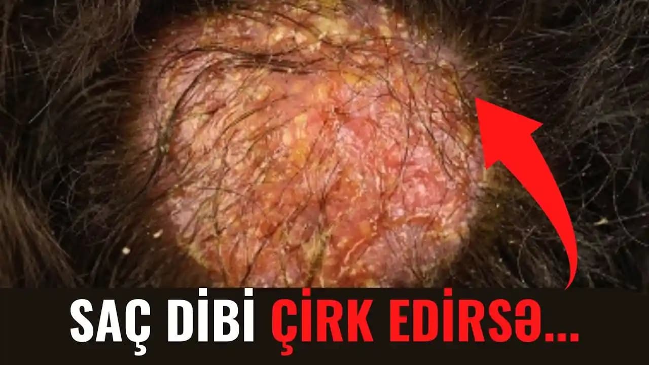 Saç Dibi İltihabını Anlamak: Nedenleri, Belirtileri ve Etkili Çözüm Yolları