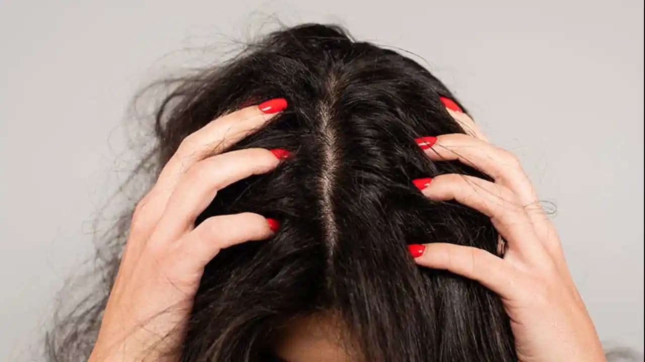 Saçtaki Mantarın Nedenleri, Belirtileri ve Güvenli Tedavi Yöntemleri