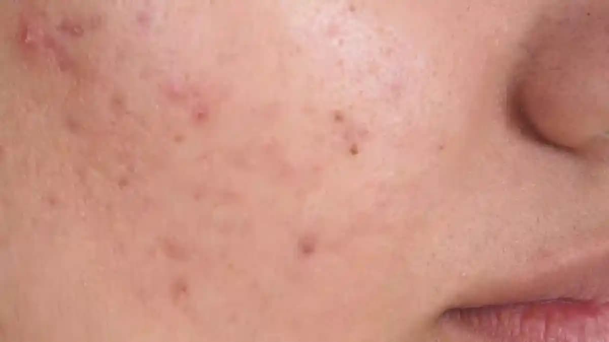 Şiş Sivilce Nedir, Nedenleri ve Etkili Tedavi Yöntemleri Hakkında Detaylı Bilgi