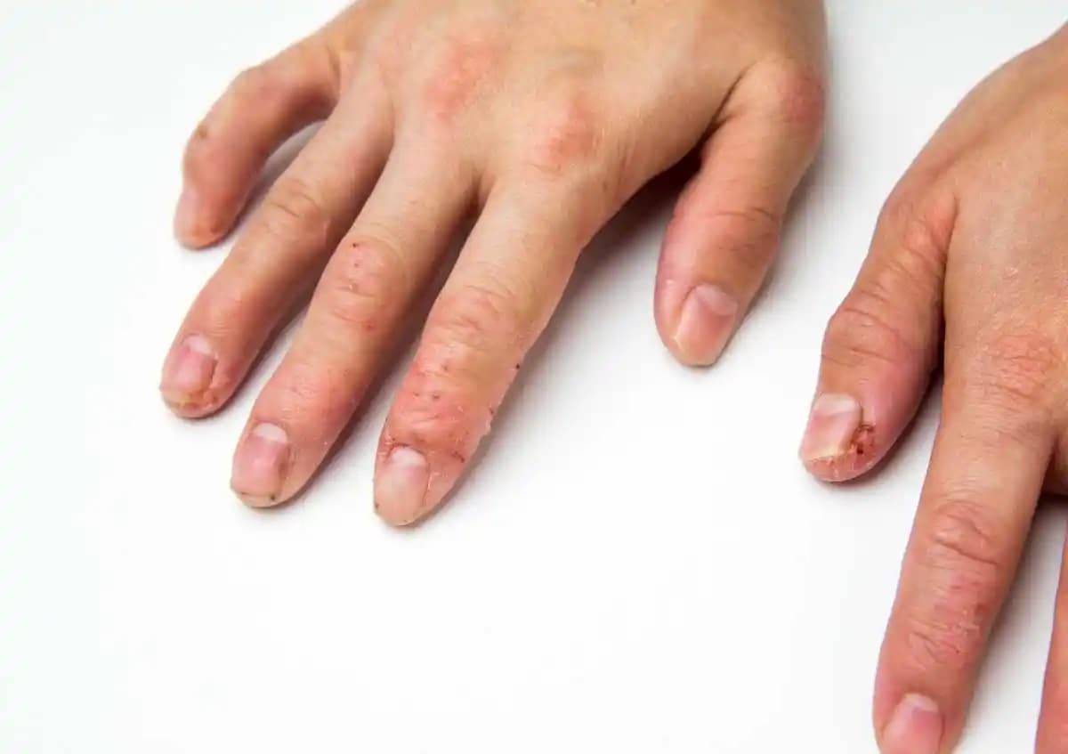 Sulu Yara Nedir, Neden Oluşur ve Kozmetik Bakımda Önemi Hakkında Kapsamlı Bilgi