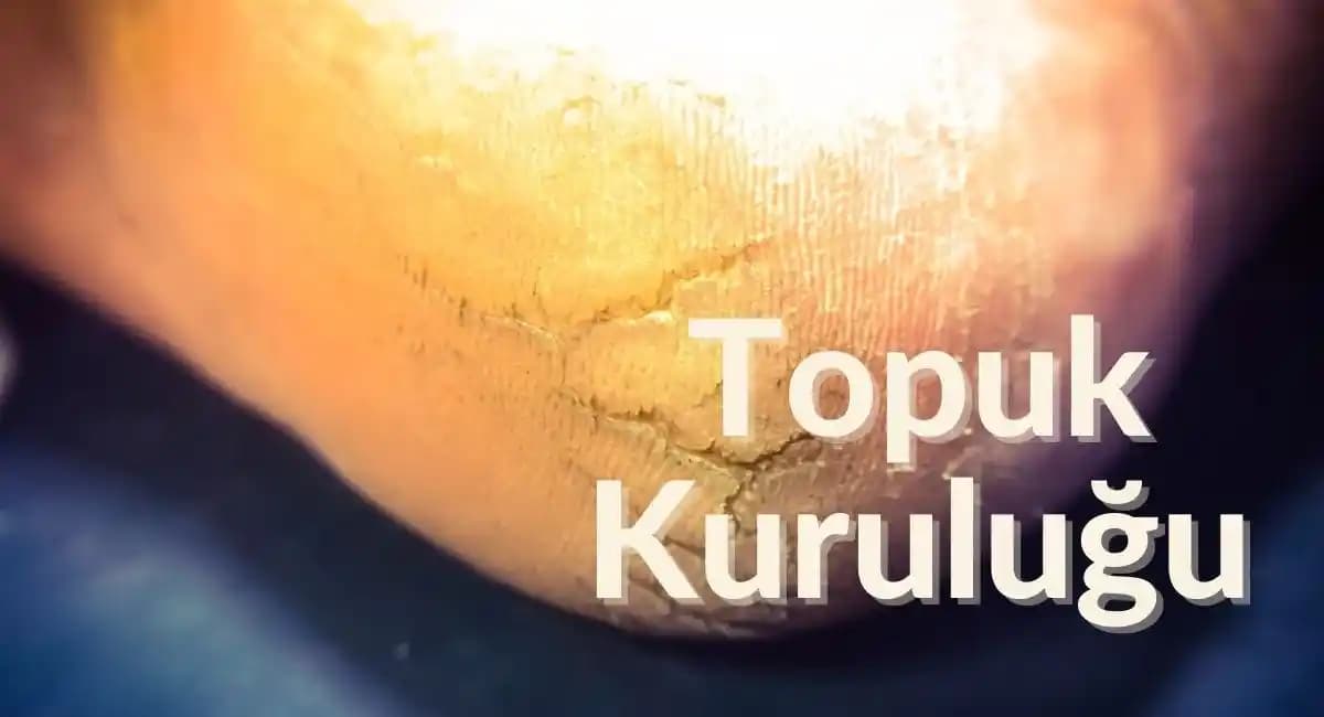 Topuk Kuruluğu ve Çatlaması İçin Etkili Bakım Yöntemleri ve Çözüm Tavsiyeleri