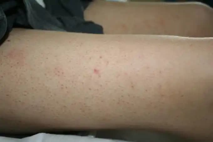 Üst Bacakta Sivilce Sorunu ve Etkili Çözüm Yolları Hakkında Bilmeniz Gerekenler