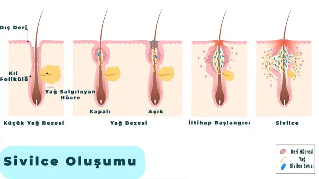 Vücutta Sivilce Nedenleri ve Etkili Önleme Yöntemleri Hakkında Kapsamlı Bilgi