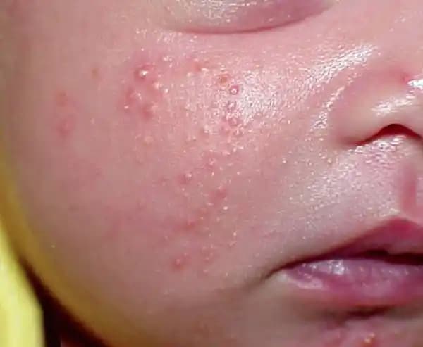 Yeni Doğan Bebeklerde Yüz Sivilcesi Nedenleri ve Uygun Bakım Yöntemleri