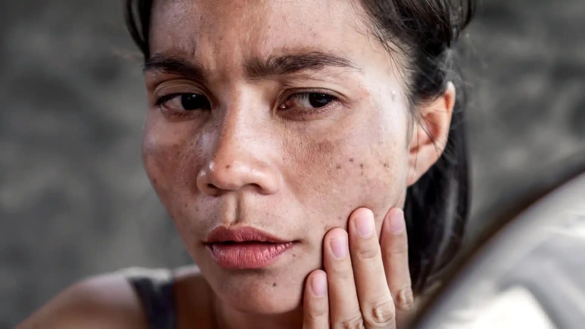 Yüz Kararması Nedir, Nedenleri ve Etkili Çözüm Yöntemleri Hakkında Bilgiler