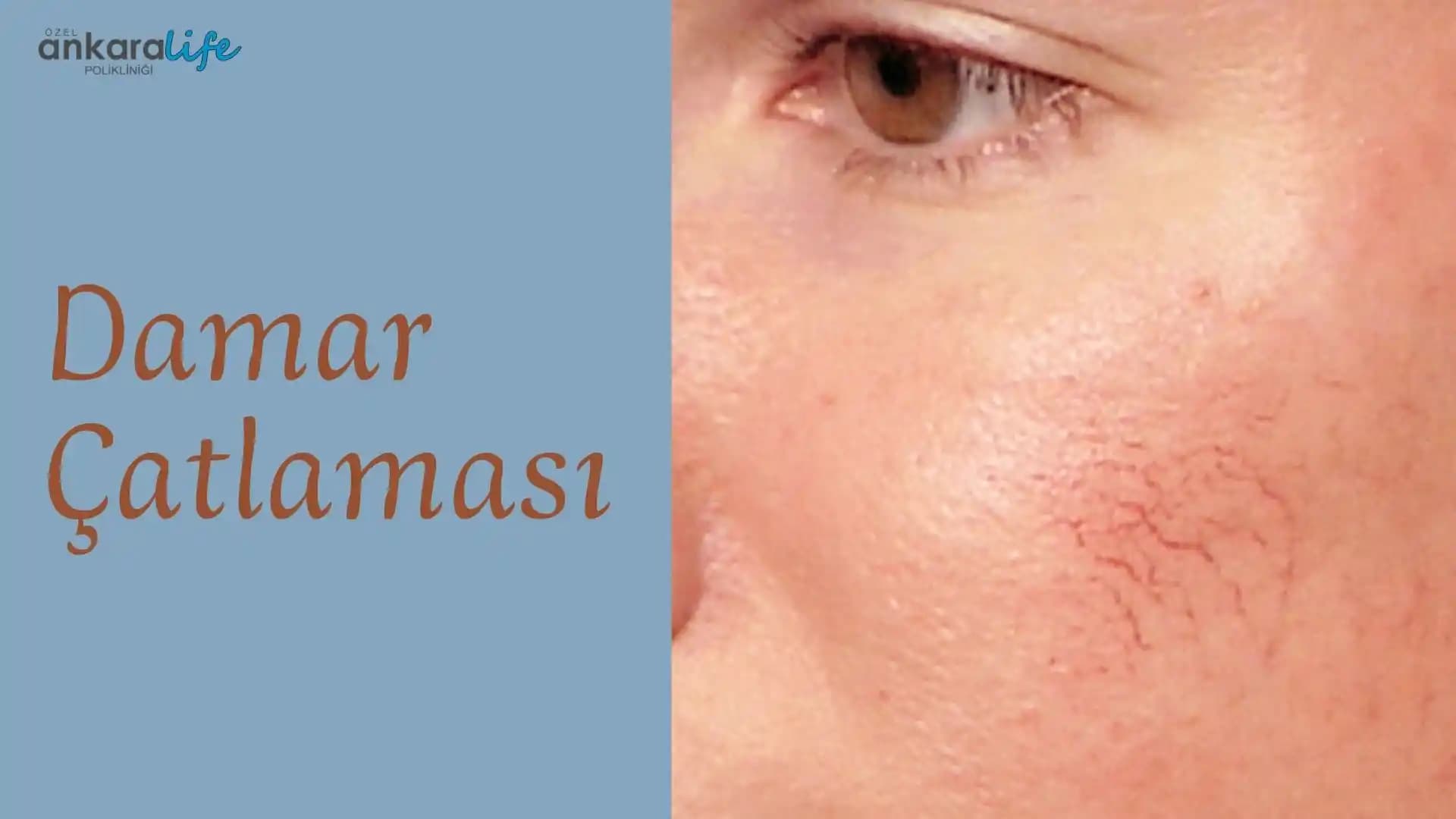 Yüzde Damar Çatlaması Nedenleri, Belirtileri ve Etkili Çözüm Yöntemleri