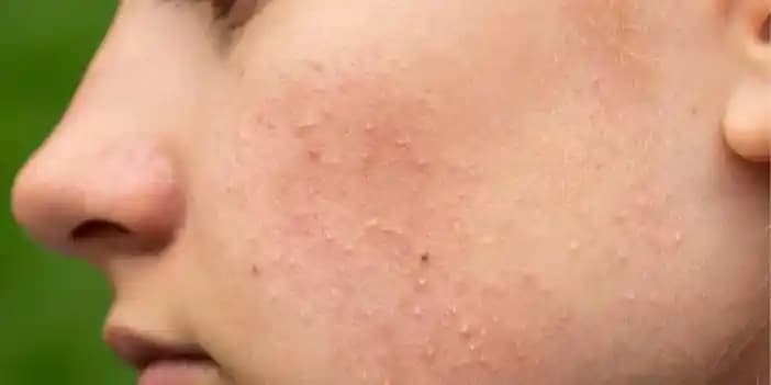 Yüzde Sivilce ve Şişlikler: Nedenleri, Belirtileri ve Etkili Çözüm Yöntemleri