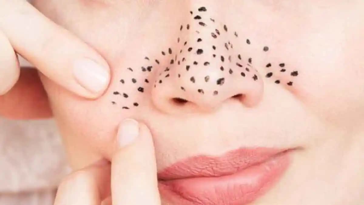 Yüzde Siyah Lekeleri Nedenleri ve Etkili Tedavi Yöntemleri Rehberi