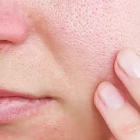 Yüzdeki Gözeneklerin Açılma Nedenleri ve Kontrol Altına Alma Yöntemleri