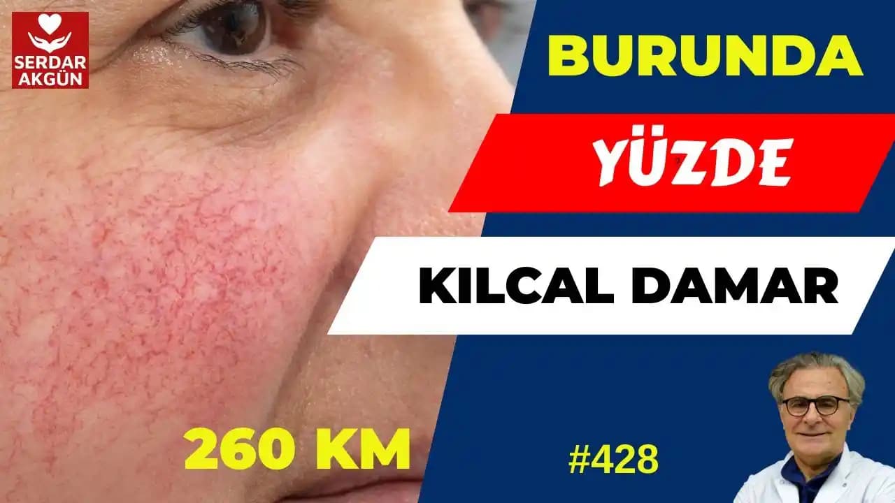 Yüzdeki Kılcal Damar Çatlamasına Karşı Etkili Doğal ve Kozmetik Çözümler