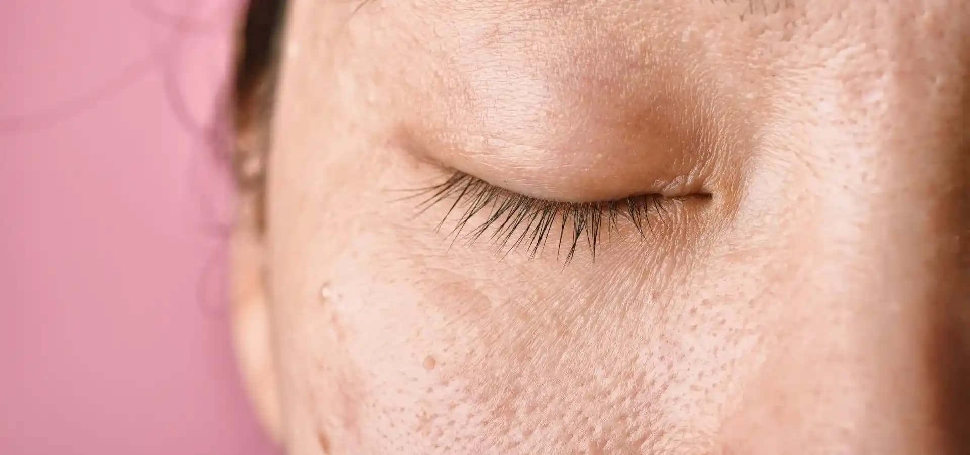 Yüzdeki Siyah Lekeleri Azaltmanın Etkili Yolları ve Uzman Tavsiyeleri