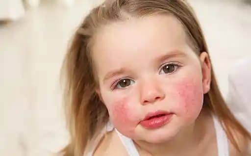 Alerjik Yüz Kızarması ve Cilt Hassasiyetine Karşı Doğru Bakım Yöntemleri