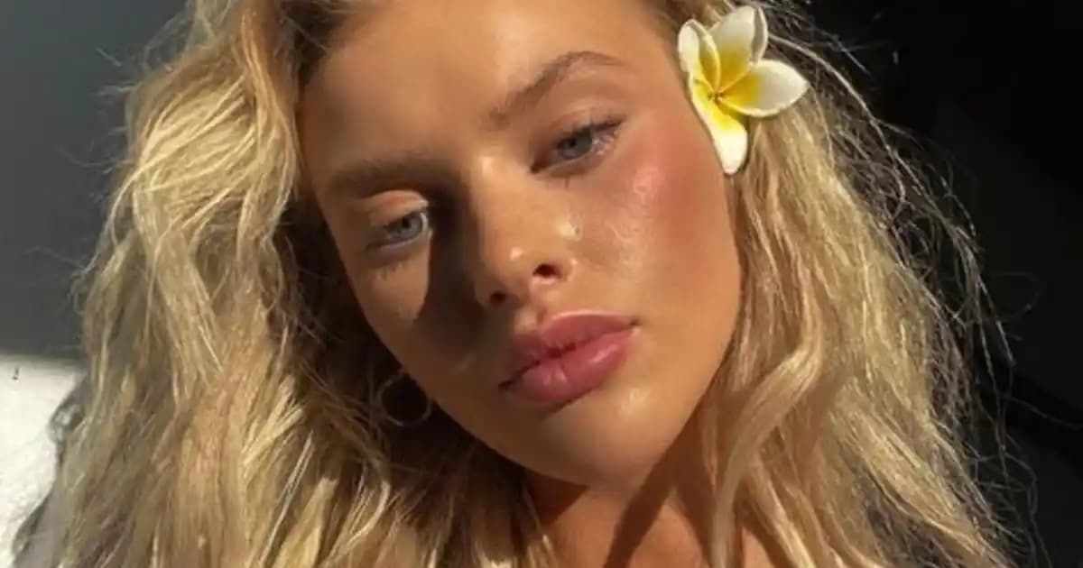 Alındaki Komedonların Nedenleri ve Etkili Tedavi Yöntemleri Hakkında Bilgi