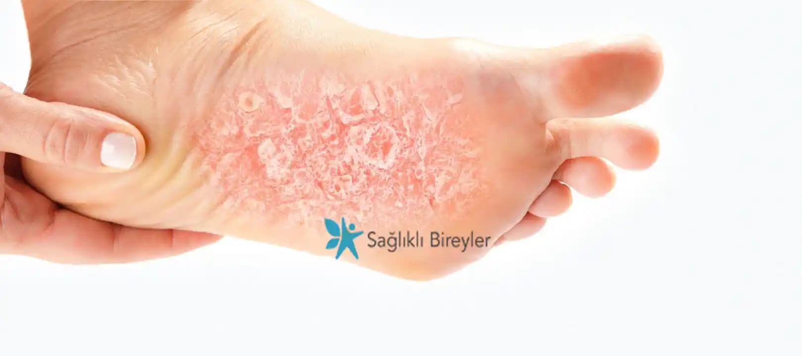 Ayak Egzaması: Belirtileri, Nedenleri ve Kozmetik Bakım Yöntemleri Hakkında Bilgi