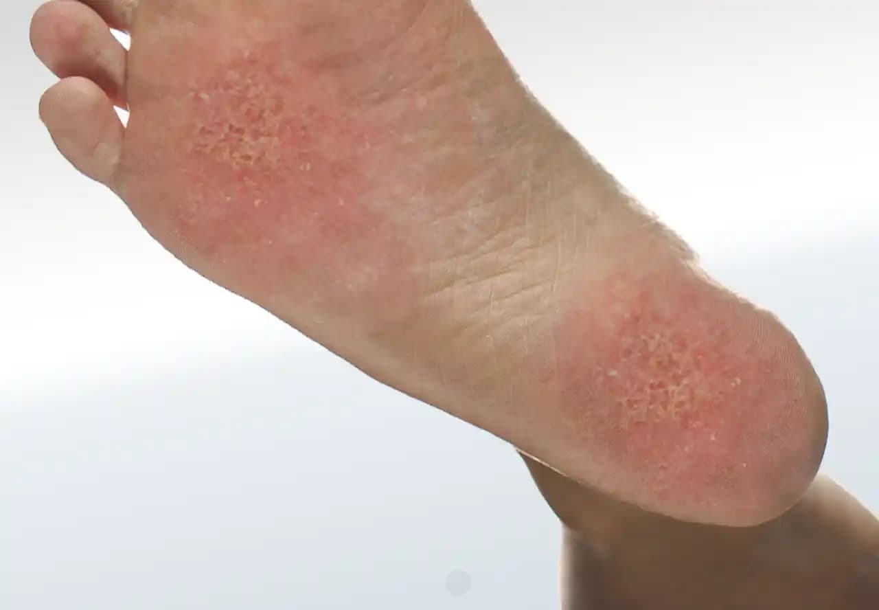 Ayakta Egzama: Belirtiler, Nedenler ve Etkili Tedavi Yöntemleri Hakkında Bilgi