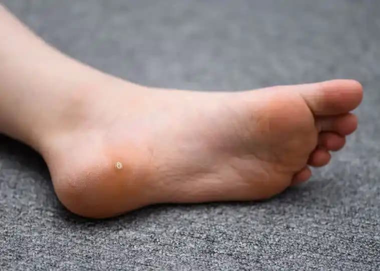 Ayakta Siğil Nedenleri ve Oluşum Mekanizması: Kozmetik ve Kişisel Bakım Perspektifi